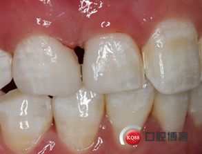 树脂美学修复两例 以最小创伤重塑自然之美